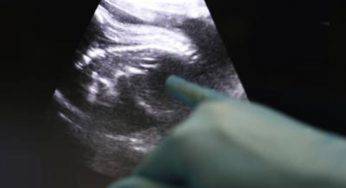Bambino Gesù: intervento miracoloso su feto di 28 settimane – Video