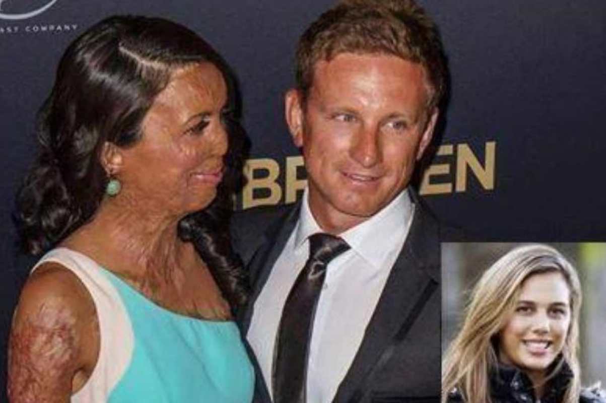 Modella sfigurata si sposa con l'uomo che non l'ha mai abbandonata