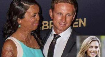 Modella sfigurata dalle ustioni sposa l’uomo che non l’ha mai abbandonata